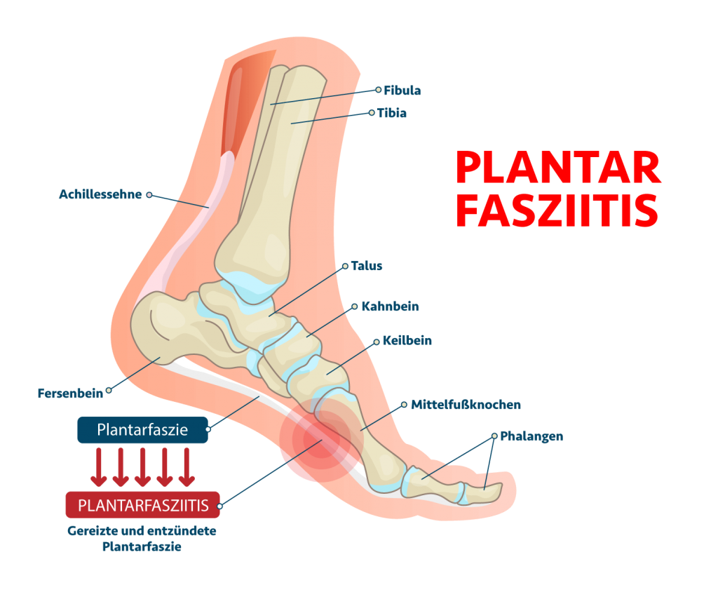 Was ist die Plantarfasziitis - Entzündung der Plantarfaszie