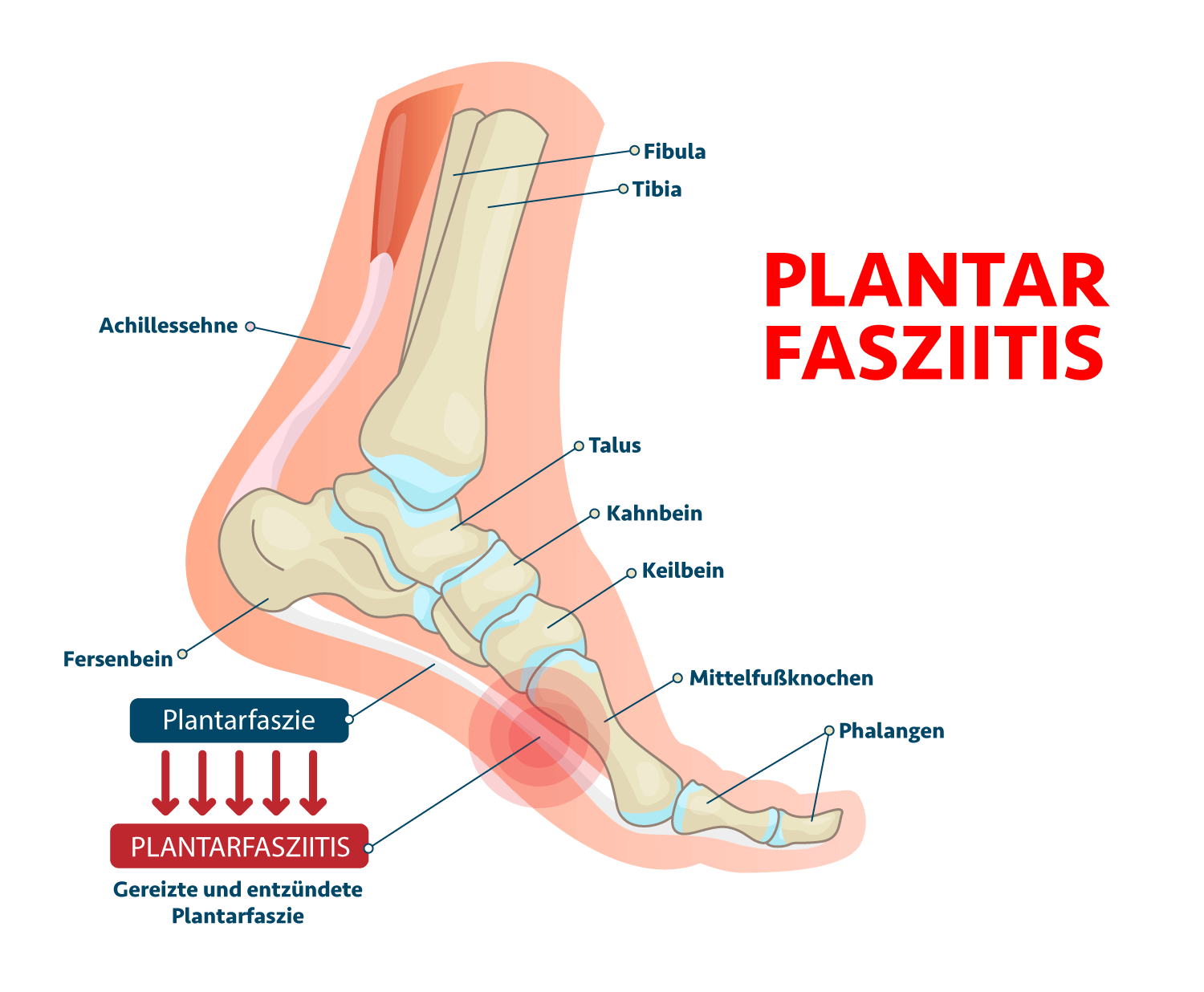 Plantarfasziitis