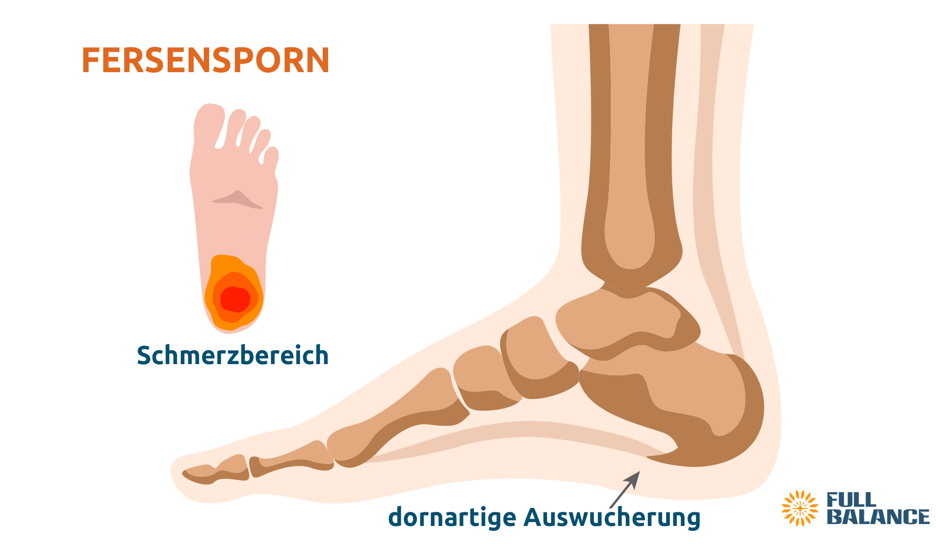 Fersensporn - schmerzhafte Entzündung Fersenspor